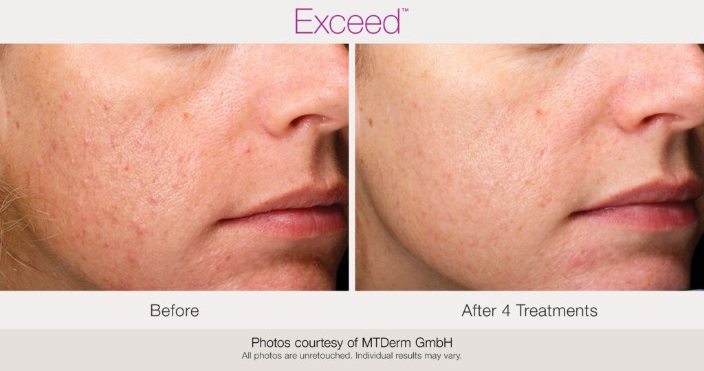 Manufacturer before-and-after comparison after four Exceed treatments, supplied by MTDerm GmbH