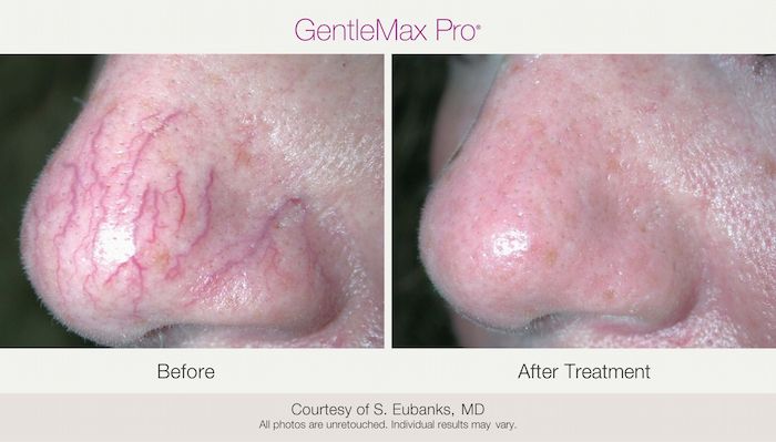 Manufacturer before-and-after comparison after three GentleMax Pro treatments
