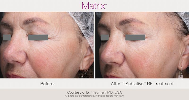 Manufacturer before-and-after comparison after one sublative radiofrequency treatment