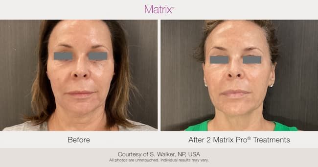 Manufacturer before-and-after comparison after two Profound Matrix treatments, supplied by S. Walker, NP