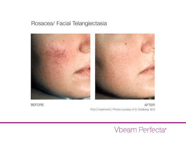 Manufacturer before-and-after comparison of rosacea and facial telangiectasia treated with Vbeam Perfecta, supplied by G. Goldberg, M.D.