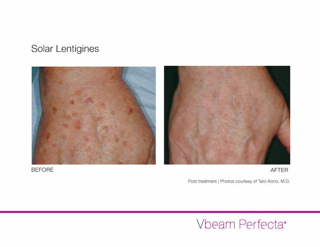 Manufacturer before-and-after comparison of solar lentigines treated with Vbeam Perfecta, supplied by Taro Kono, M.D.