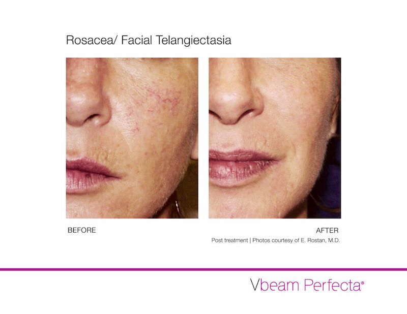 Manufacturer before-and-after comparison of rosacea and facial telangiectasia treated with Vbeam Perfecta