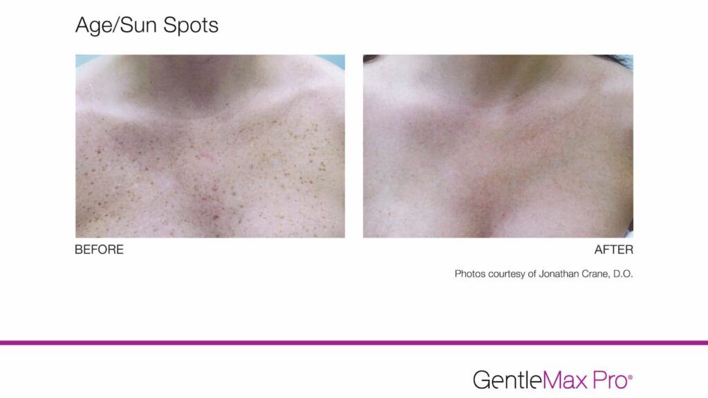 Manufacturer before-and-after comparison of sun spots treated with GentleMax Pro