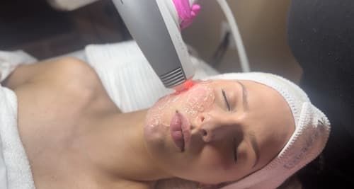A practitioner guiding a laser handpiece across a reclining client's cheek