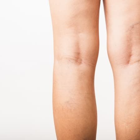 Visible veins on the backs of a person's lower legs
