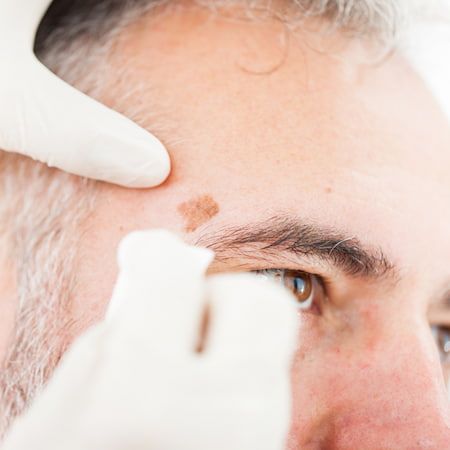 A gloved practitioner treating a small lesion beside a man's eye